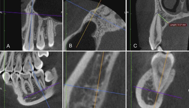 How to read cbct for dental implants