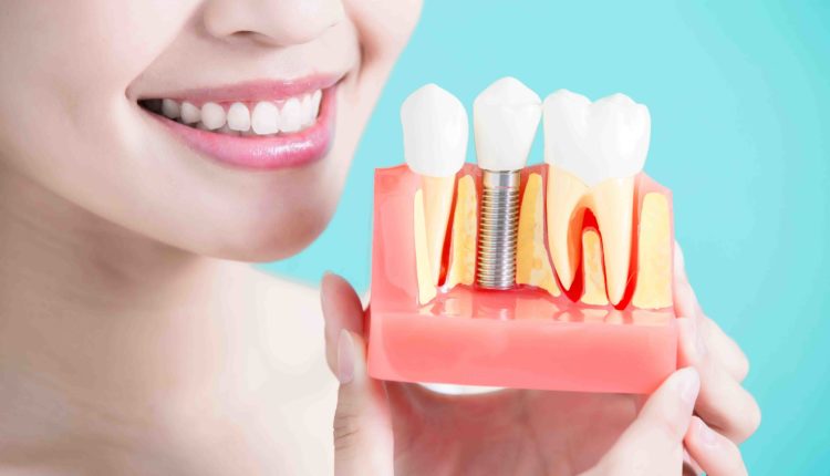 How to shop for dental implants