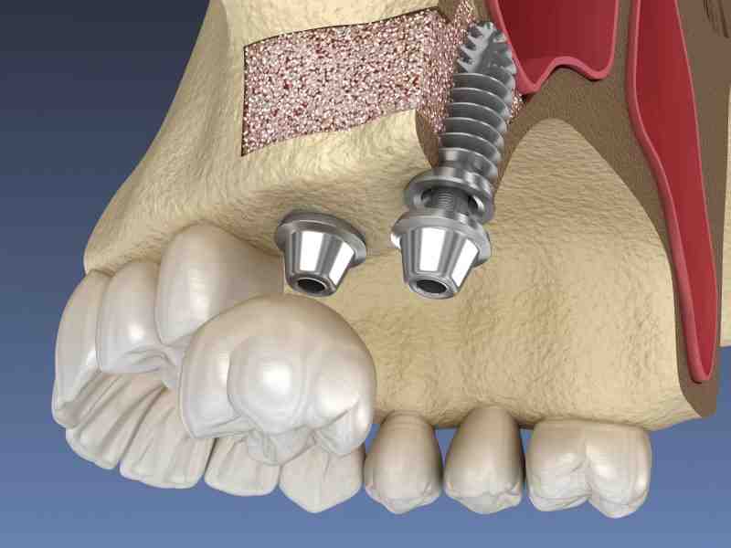 What is a sinus lift dental implants Dental News Network