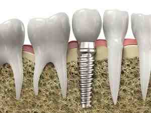 Is it ever too late to get dental implants?