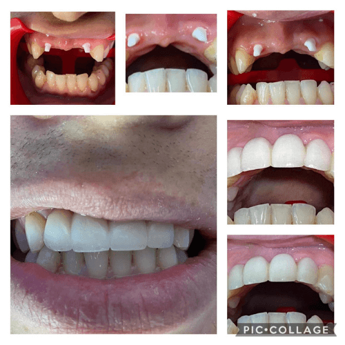 Is it safe to get dental implants in Cancun Mexico?