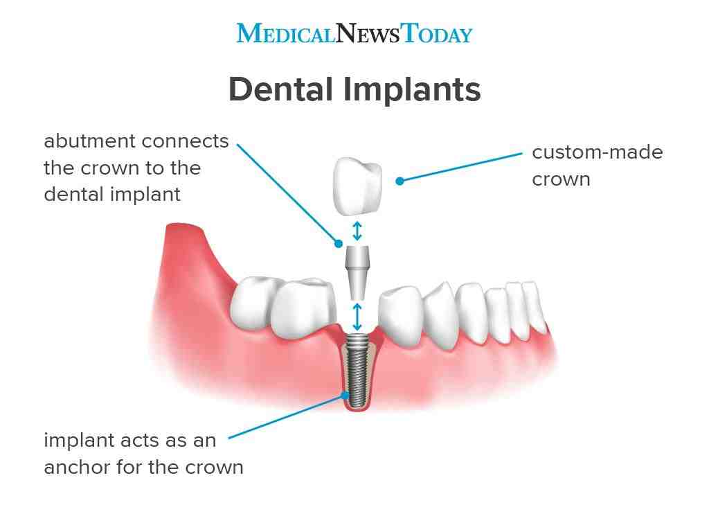 What insurance pays for dental implants Dental News Network