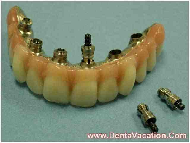 Should I go to Mexico for dental implants?