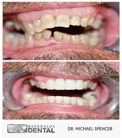 Should a periodontist do an implant?