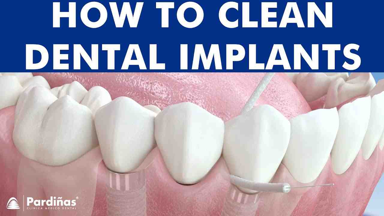 How to floss dental implants Dental News Network
