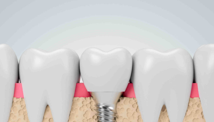 What are dental implant crowns made of