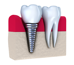 What are the long term effects of dental implants?