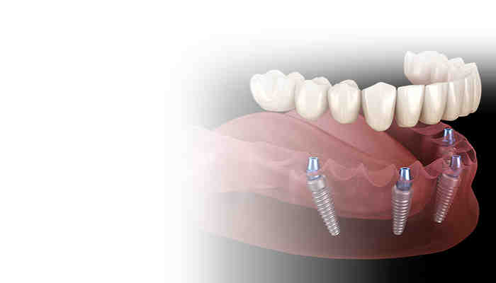 What are the problems with all on 4 dental implants?