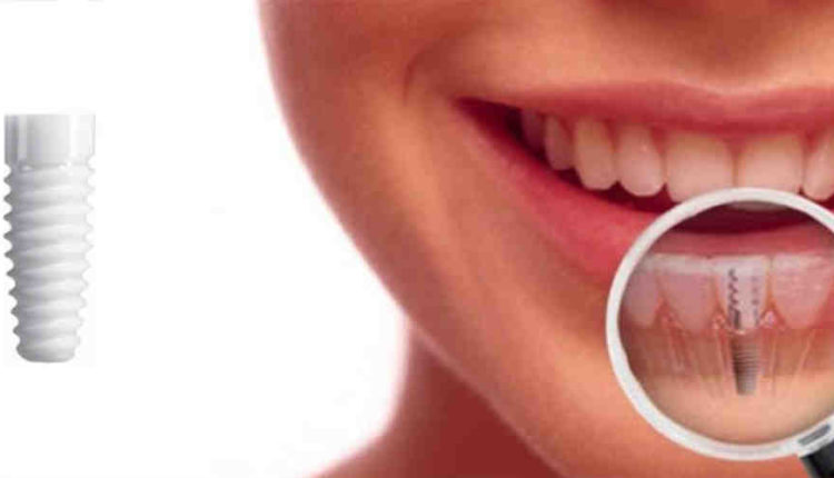 What are the side effects of dental implants