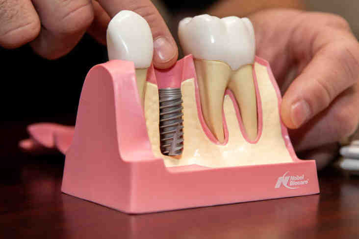 What are the symptoms of a dental implant rejection?