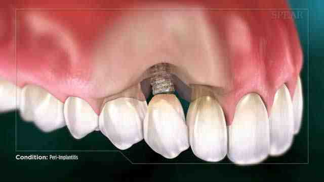What can cause a dental implant to fail?