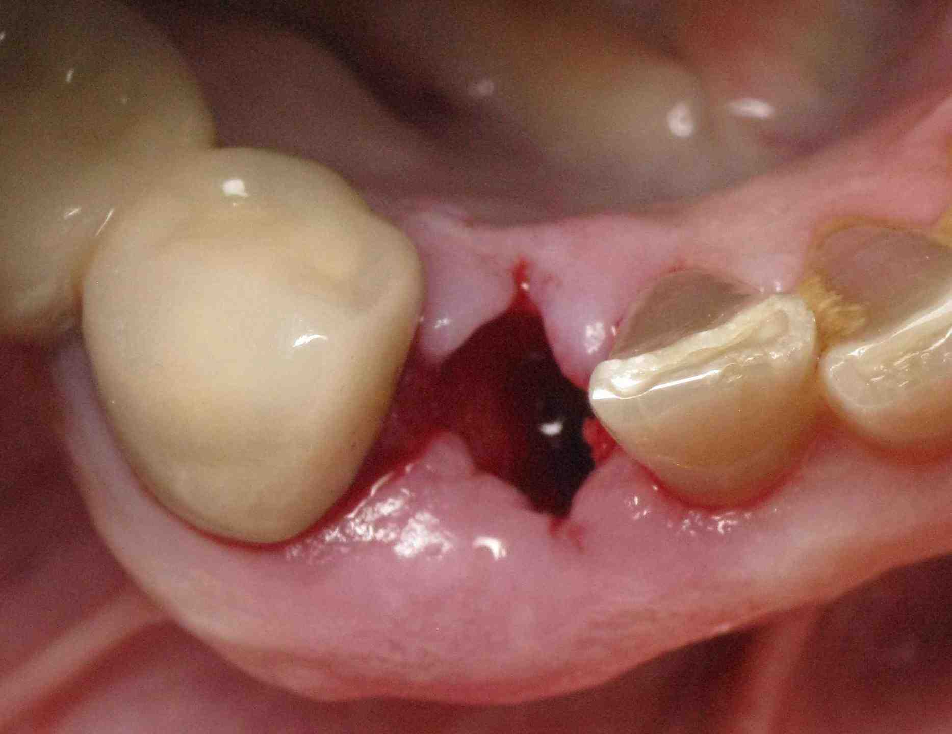 What can go wrong with dental implants?