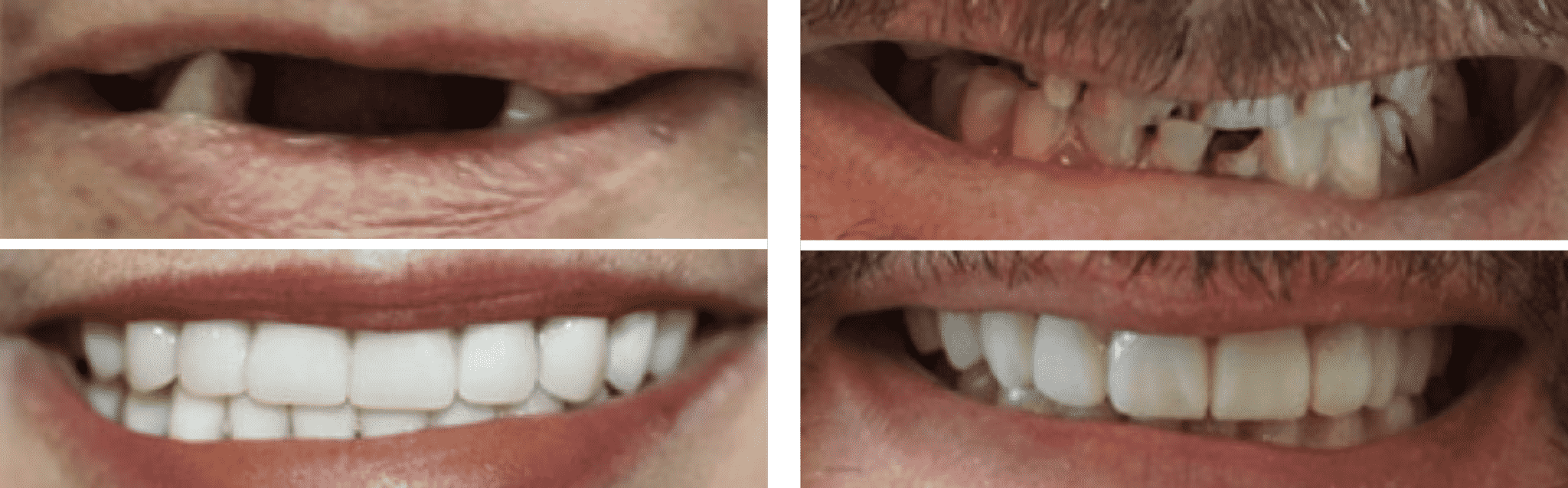 What causes dental implant failure?