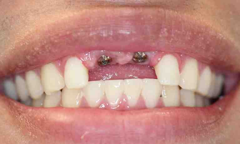 What dental procedures does the VA cover?