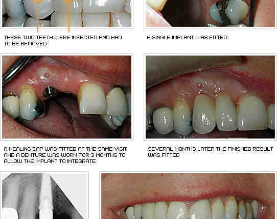 What happens to my dental implants after i die
