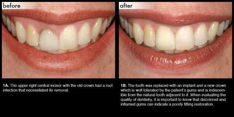 What happens when dental implant fails?