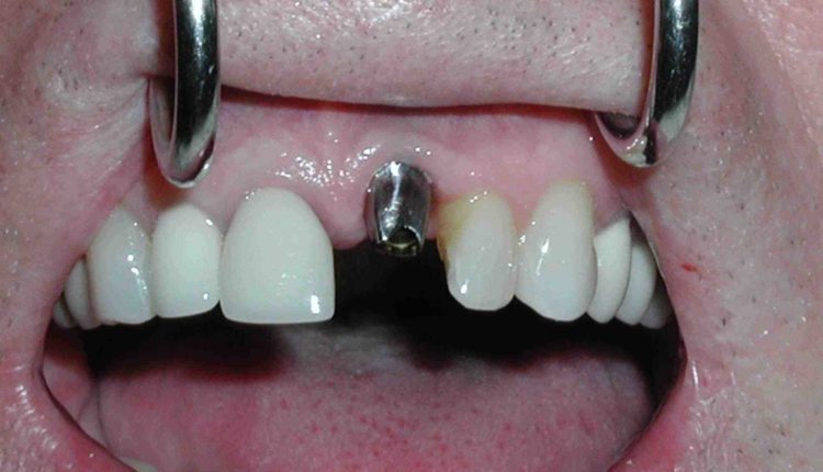 What is a dental implant abutment