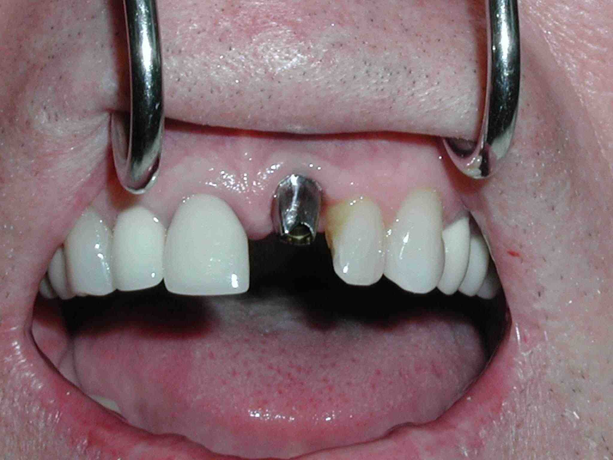 Define Pier Abutment In Dentistry at Sabrina Norris blog