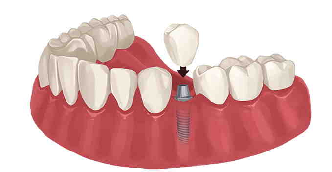 What is a reasonable price for dental implants?