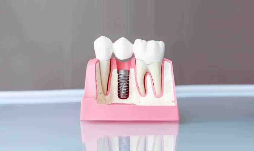 What is a reasonable price for dental implants?