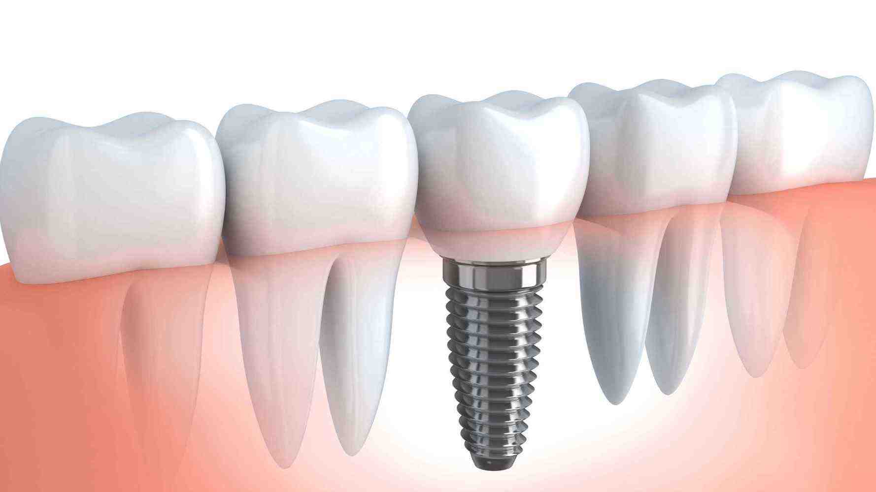 What is a reasonable price for dental implants?
