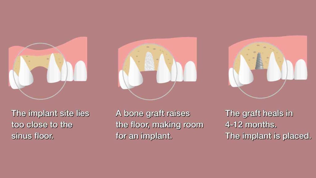 What is a sinus lift dental implants Dental News Network