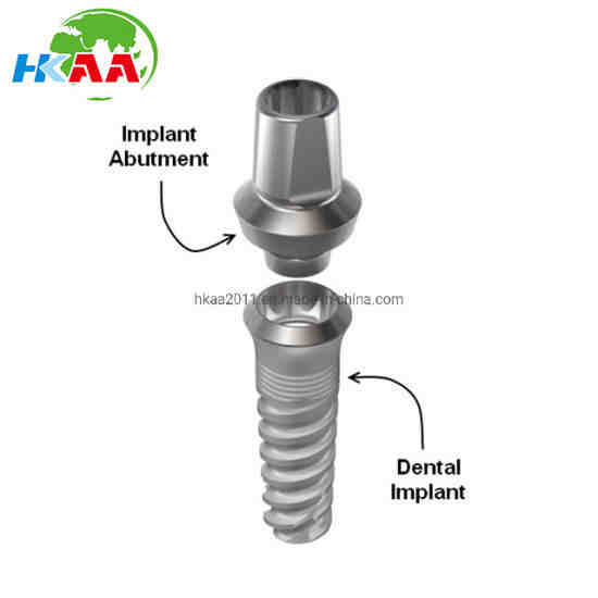 What is a dental implant abutment Dental News Network