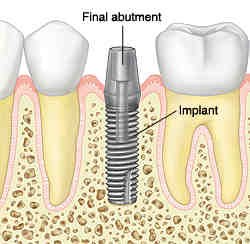 What is a dental implant abutment - Dental News Network