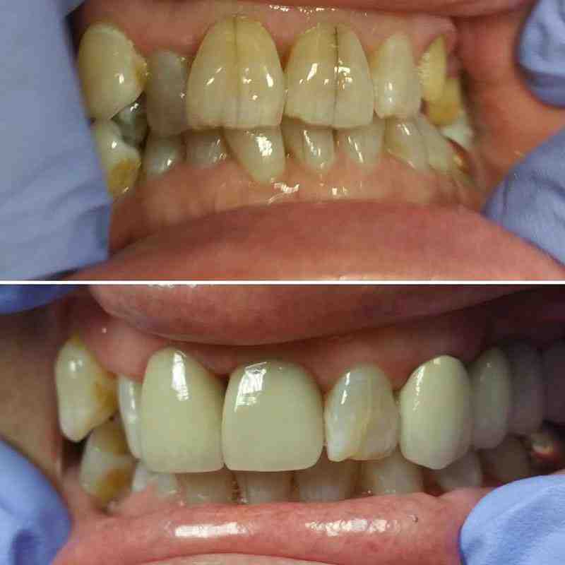 What is the average cost of full dental implants?