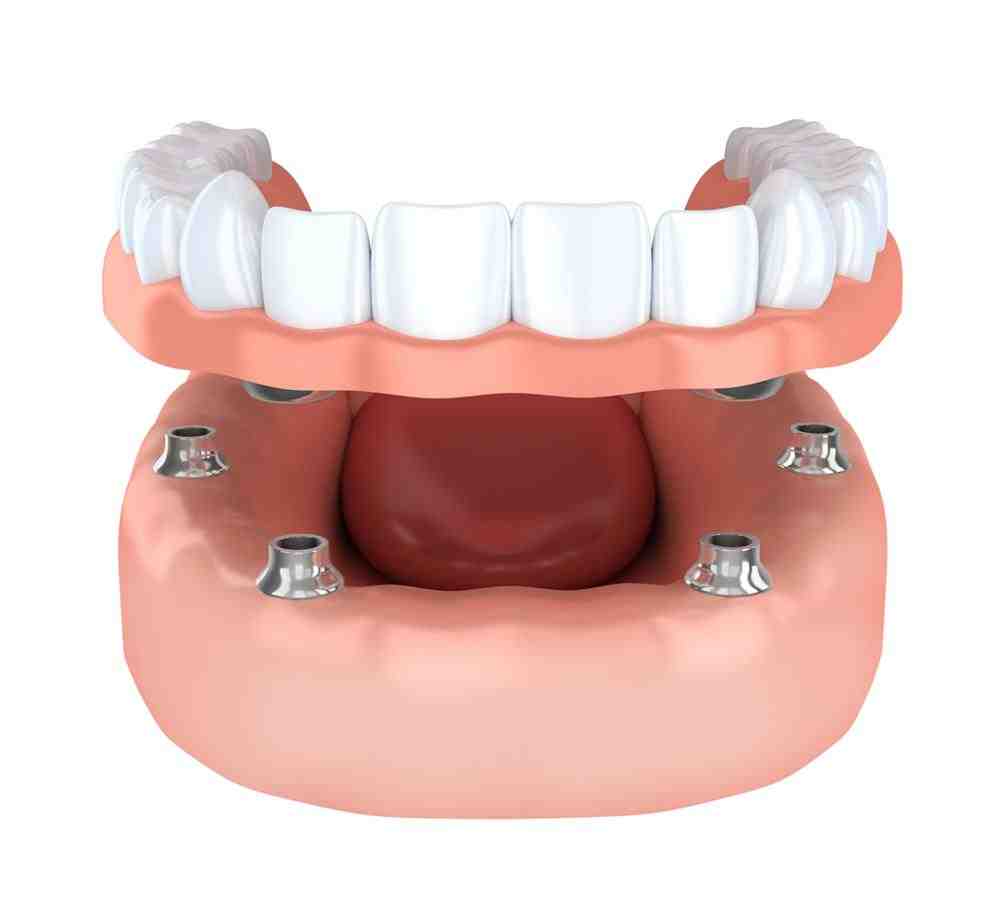 What is the average price for full mouth dental implants?