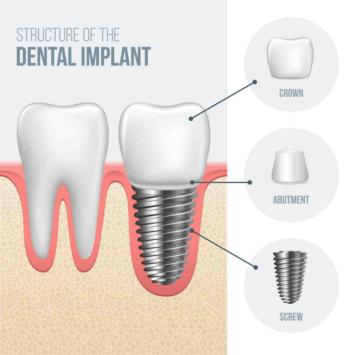 What are dental implant crowns made of - Dental News Network