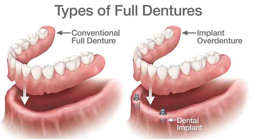 What is the cost of denture implants?