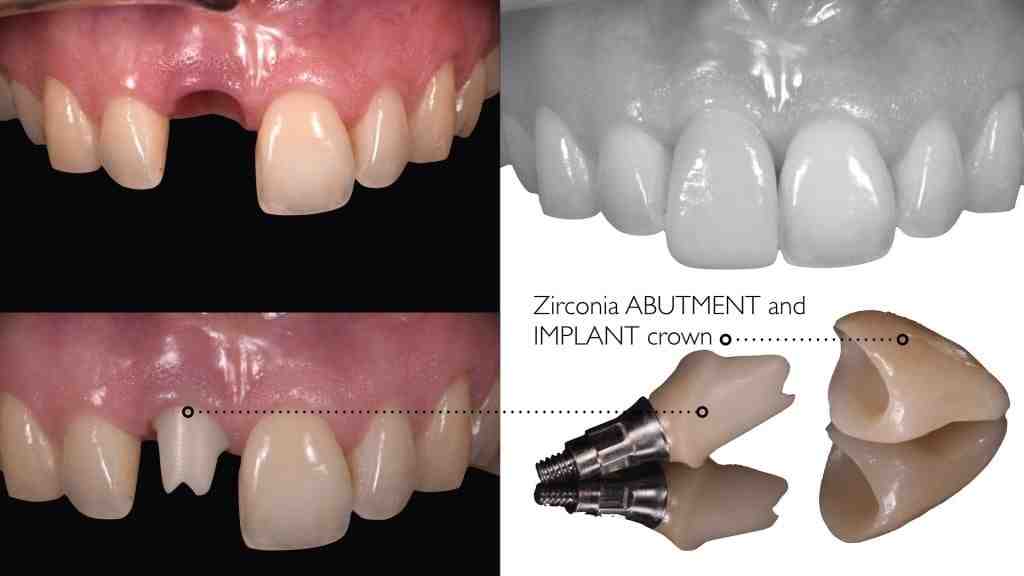 What is the downside of dental implants?