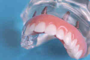 What is the success rate of mini dental implants?