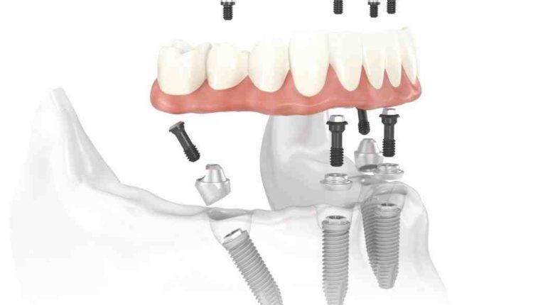 What kind of doctor does dental implants