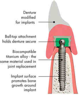 What medications can affect dental implants?