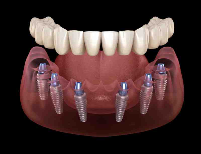 does-delta-cover-invisalign-dental-ppo-cover-explained