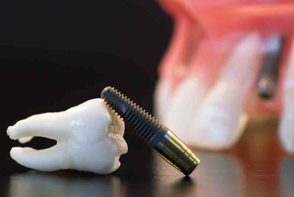 What to do if you can't afford dental implants?
