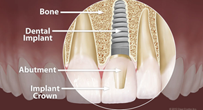 What to do when you can't afford dental implants?
