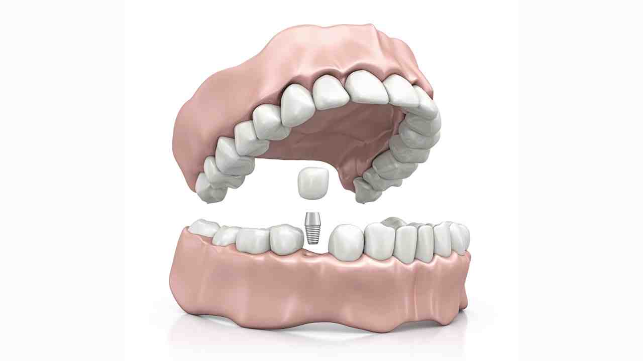What type of dentist is best for implants?