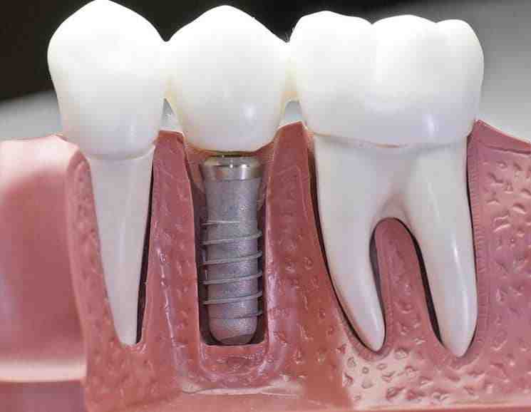 Where is the best country to get dental implants?