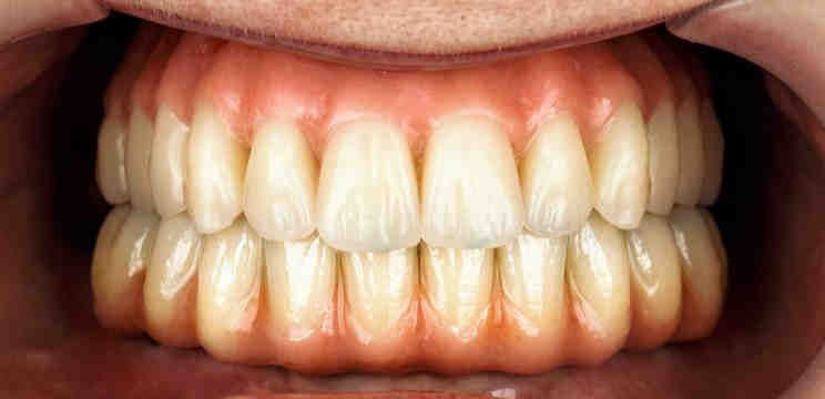 Which is better all on 4 or all on 6 dental implants?