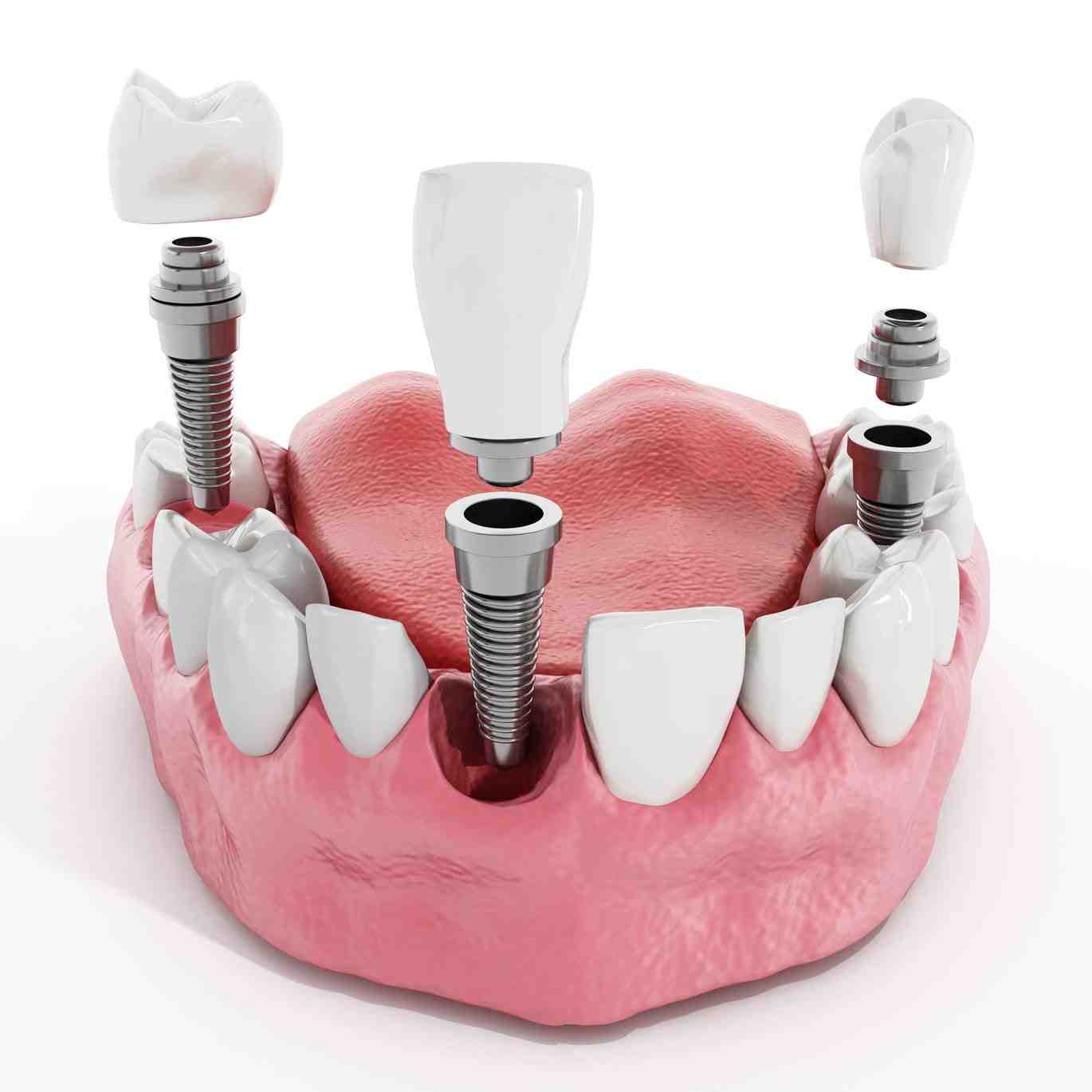 Who is not suitable for dental implants?