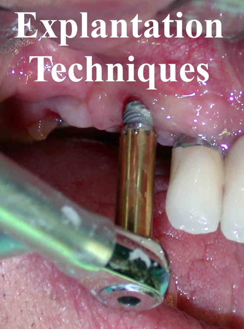 Can i use humira when having a dental implant Dental News Network