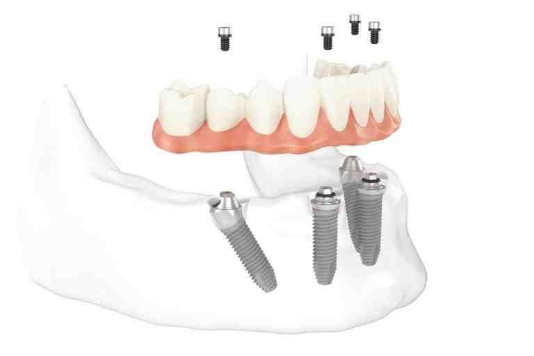 Why dental implants are bad?