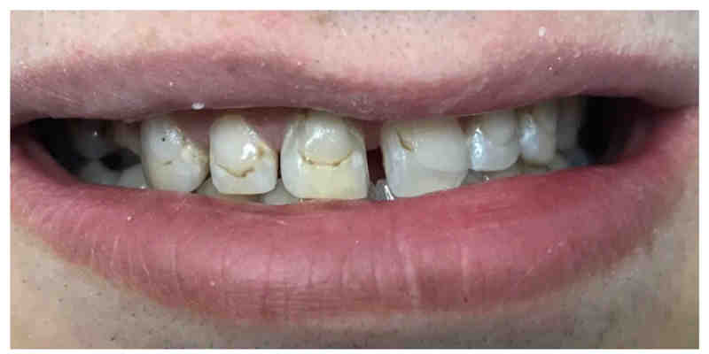 Why do my teeth have rough edges?