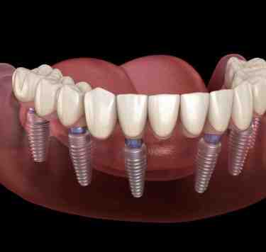 Are Dental Implants Worth the Risk?