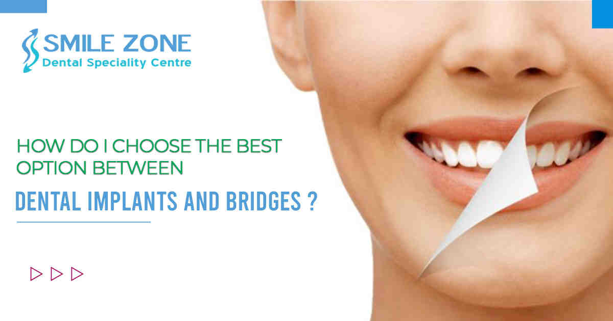 Are dental implants a bad idea?