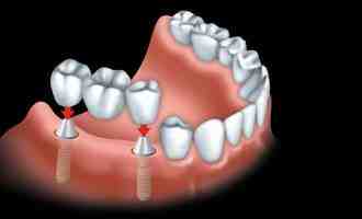 Are dental implants reliable?