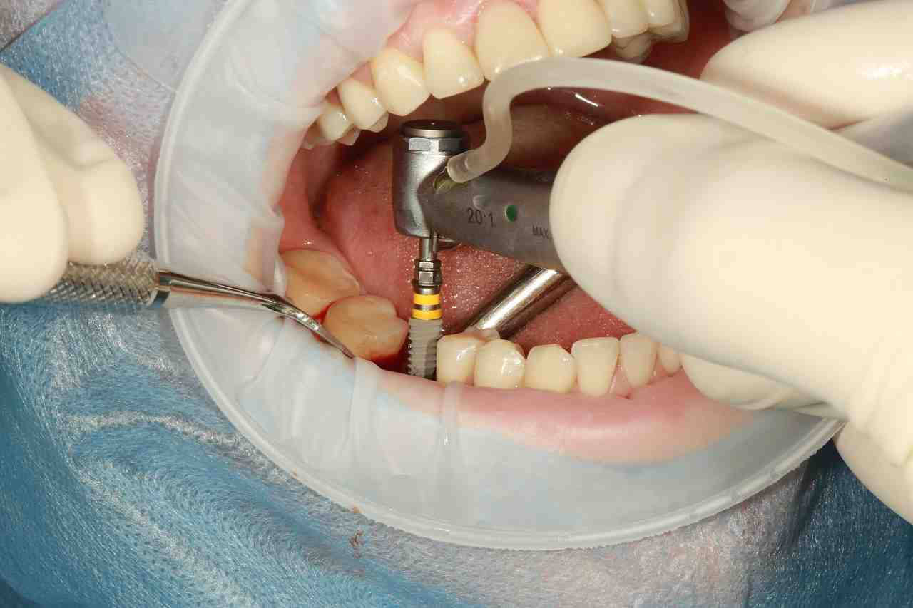 Are teeth implants risky?